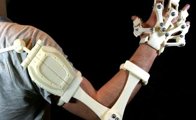 esoscheletro 3d ospedale santobono pausilipon