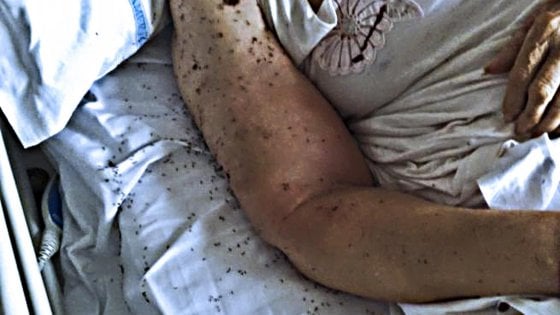 Napoli, paziente in ospedale sommersa dalle formiche