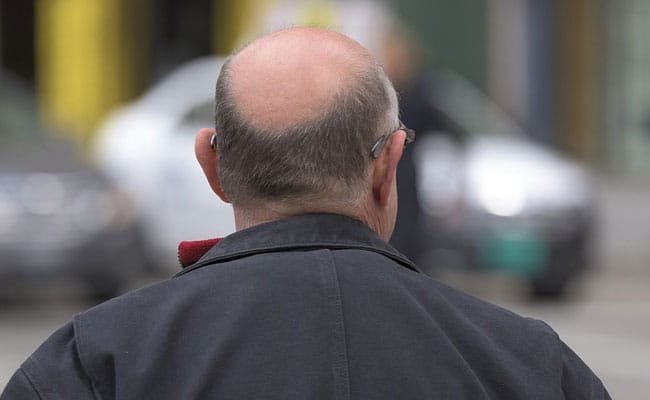 calvizie cause e rimedi naturali