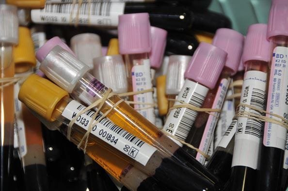 sangue giovane per combattere alzheimer