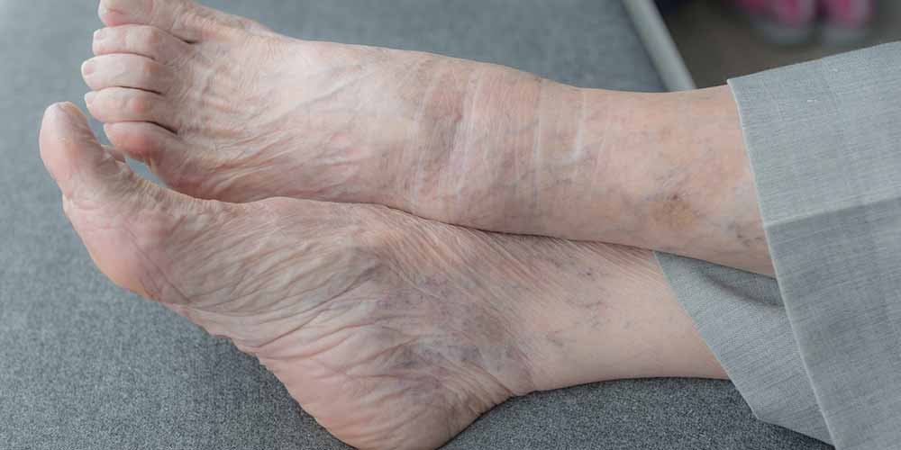 Malattie del fegato, possiamo saperlo dai piedi