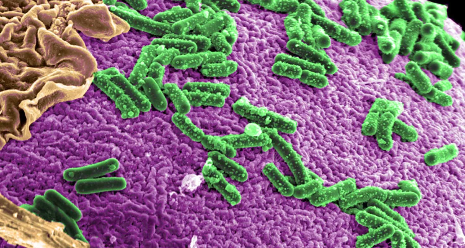 Cancro intestinale alcune sensazioni possono lanciare allarme