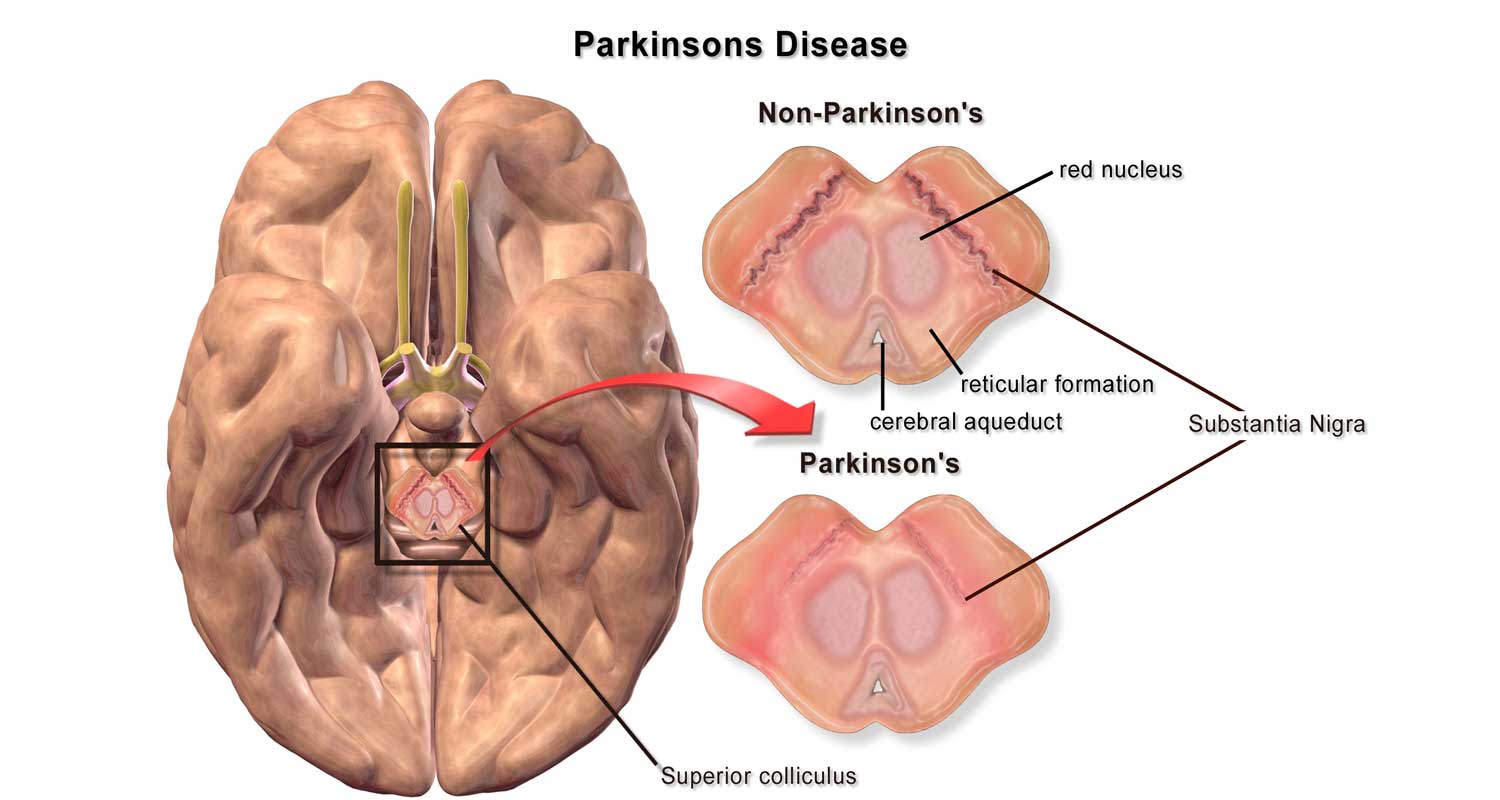 Nuovo farmaco puo rallentare il morbo di Parkinson