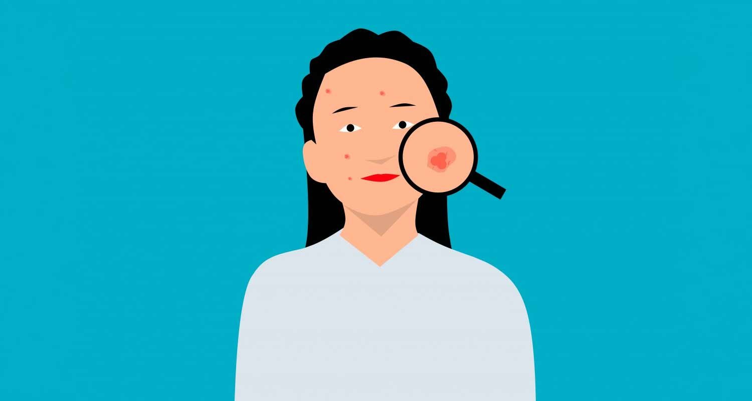 Come trattare e prevenire acne