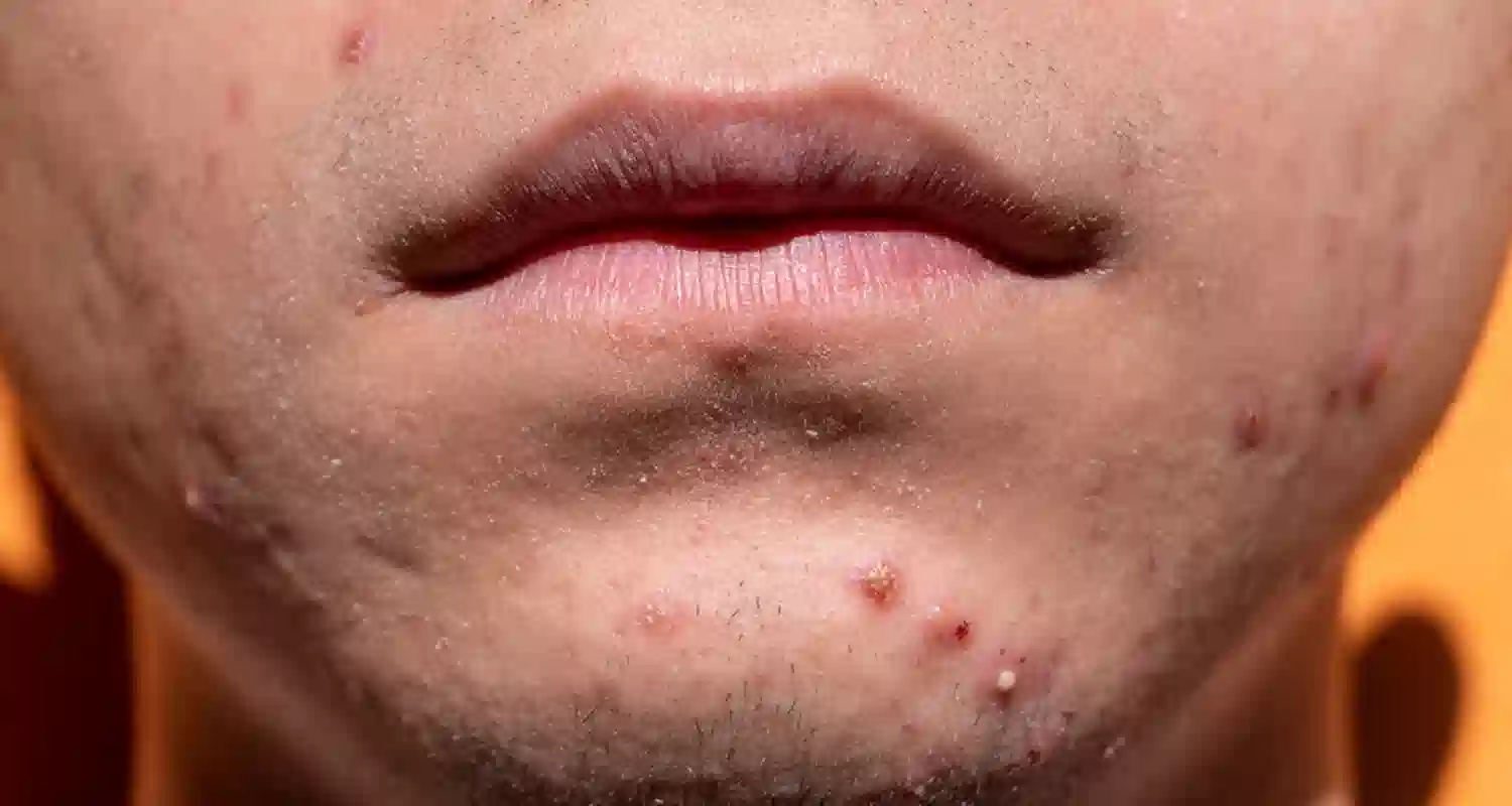 Laser per acne funziona e quante sedute ci vogliono