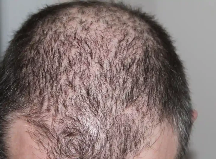 Cinque Varianti Genetiche Rare Collegate alla Calvizie Maschile