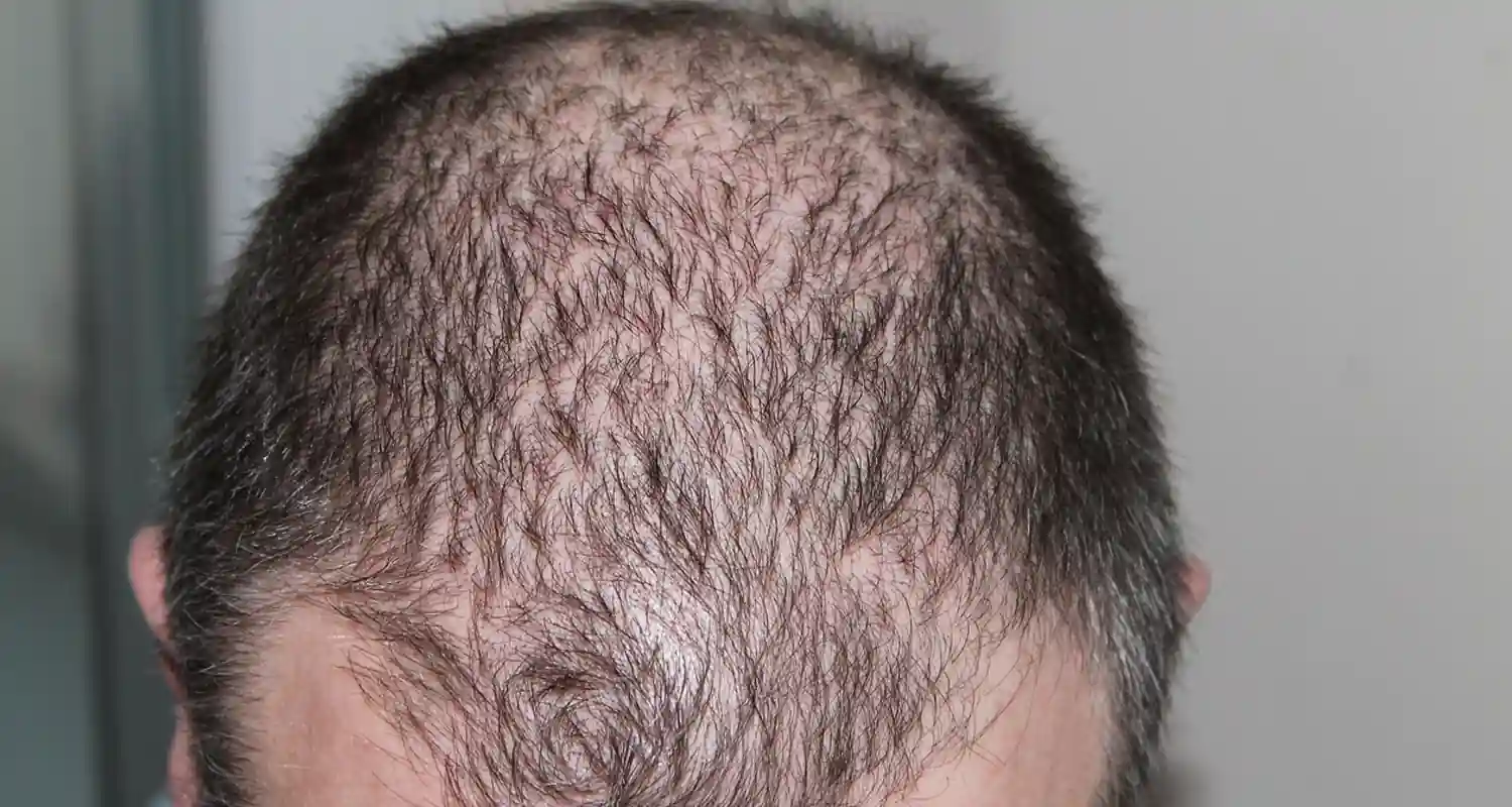 Cinque Varianti Genetiche Rare Collegate alla Calvizie Maschile